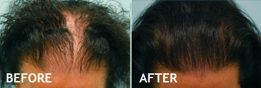 Before hair transplant surgery and after hair transplant surgery photos show the dramatic difference that Ava Hair Restoration clients can expect. Are you a woman with female pattern baldness? Do you have hair loss or do you fear you're going bald? Ava Hair Restoration offers hair loss solutions for women's hair restoration, hair replacement, surgical and non-surgical hair restoration solutions. Ava Hair Restoration is a southern California women's hair restoration company, located in San Diego, California, in the pristine coastal community of Carlsbad, California. Local residents receive: Carlsbad women's hair restoration solutions, Encinitas women's hair restoration solutions, Oceanside women's hair restoration solutions, Del Mar women's hair restoration solutions, Rancho Santa Fe women's hair restoration solutions, La Jolla women's hair restoration solutions, and San Diego women's hair restoration solutions. At Ava Hair Restoration, you are always seen by a board certified, highly respected medical doctor and surgeon. Out of town patients bring their families and make a vacation out of their women's hair restoration, women's hair transplant procedure.